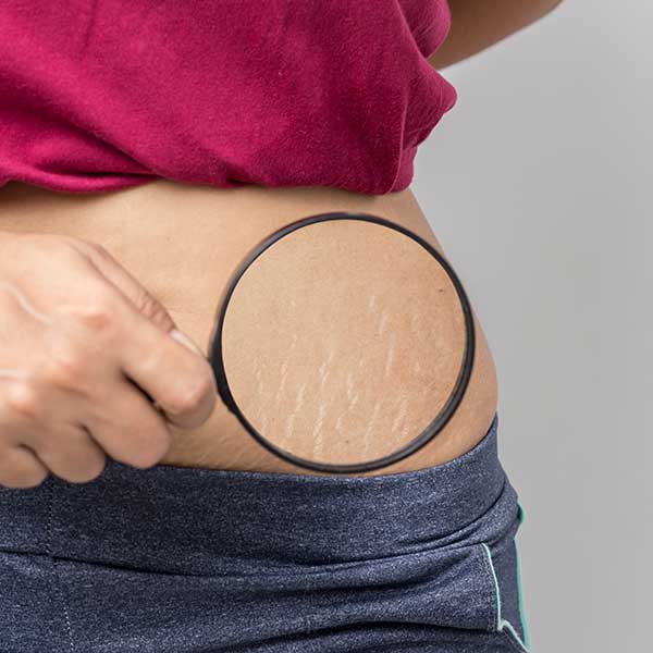 how to remove stretch marks