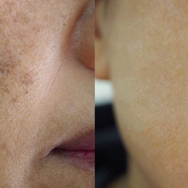 dark spots
